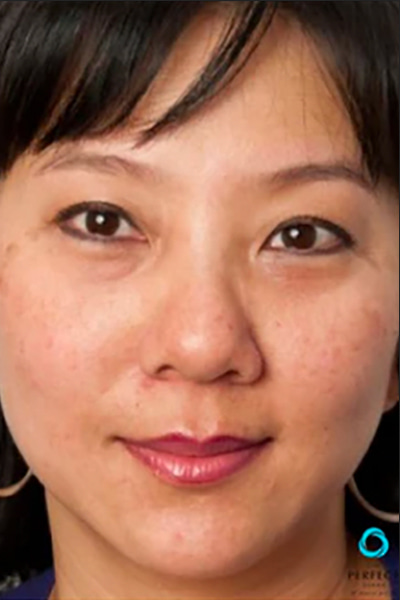 Avant traitement peeling chimique texture peau — Institut V