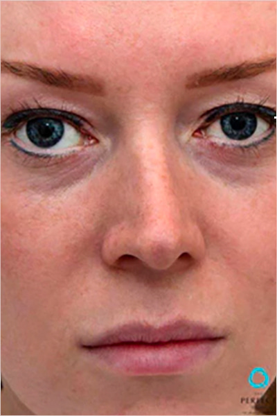 Apr&egrave;s &mdash; Dommages du soleil et taches de rousseur