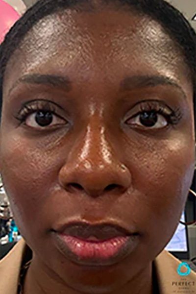 Apr&egrave;s &mdash; Teint irr&eacute;gulier