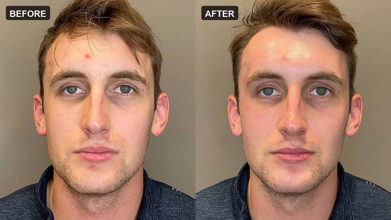 Real before-and-after HydraFacial comparison at Institut V